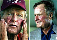 Старший Буш покрылся язвами